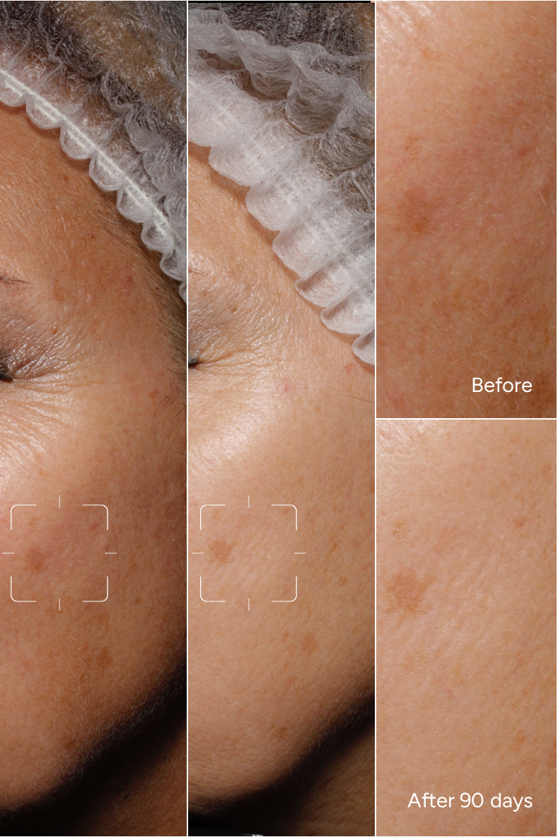 Formula 45 - AGE SPOT ERASER - Age related dark spots / sun excess