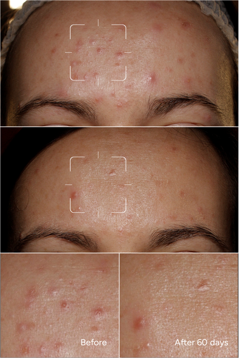 Formula 36 – Pelle Acneica Adolescente