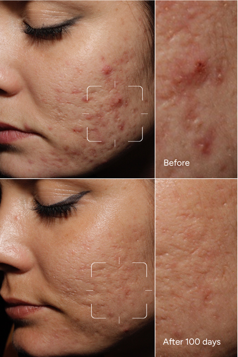 Formula 39 – ACNE PRONE Melanin-Rich Skin