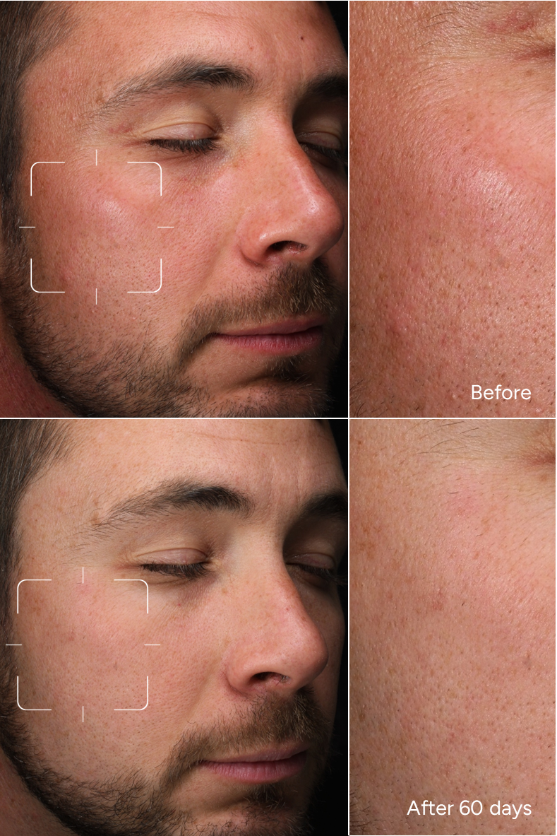 Formule 4 – SUPER ANTIOX Peaux Sensibles