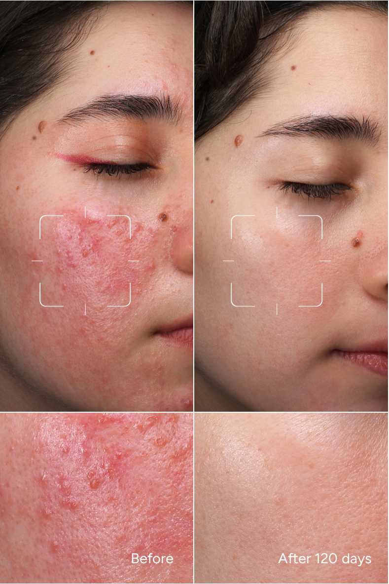 Formula 40 – Neutralizzatore Aspetto Rosacea