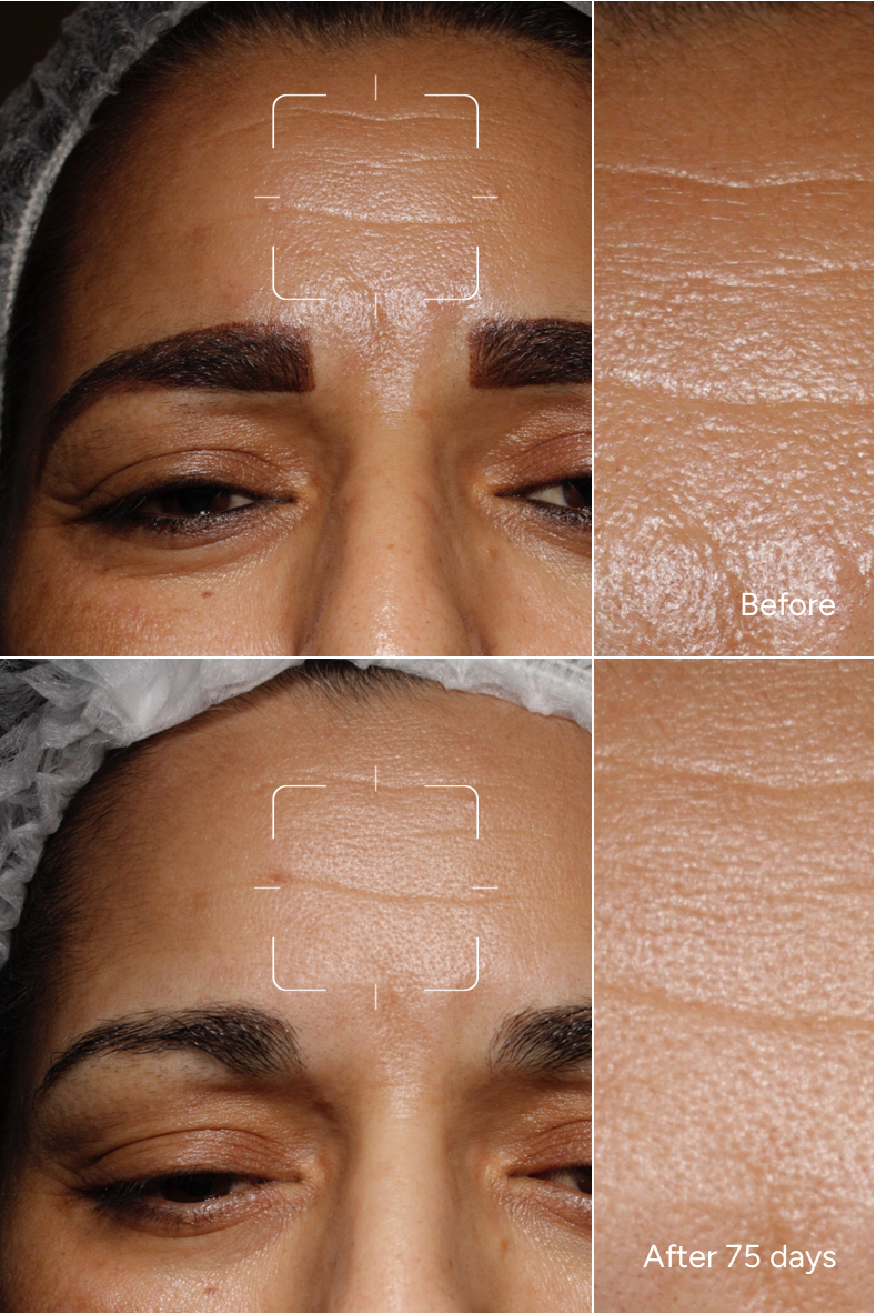 Formula 27 - Pore minimizer