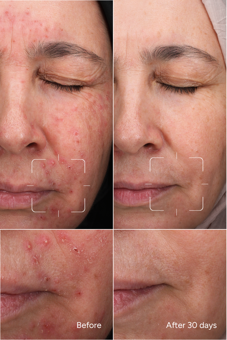 Formule 37 – Peaux Acnéiques de la Femme Adulte