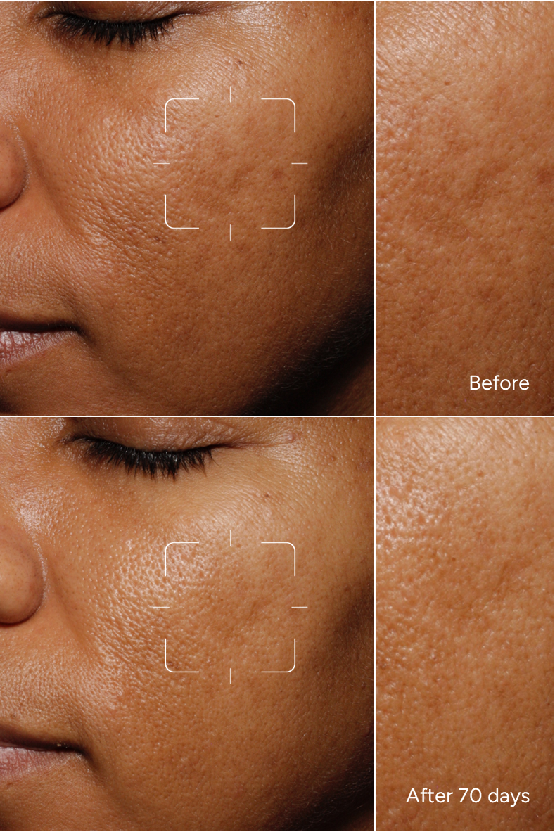 Formula 44 – Pigmentazione Ormonale Pelle Ricca di Melanina