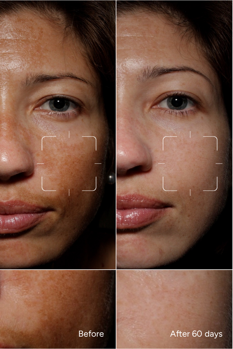 Formel 43 – Hormonelle Pigmentierung