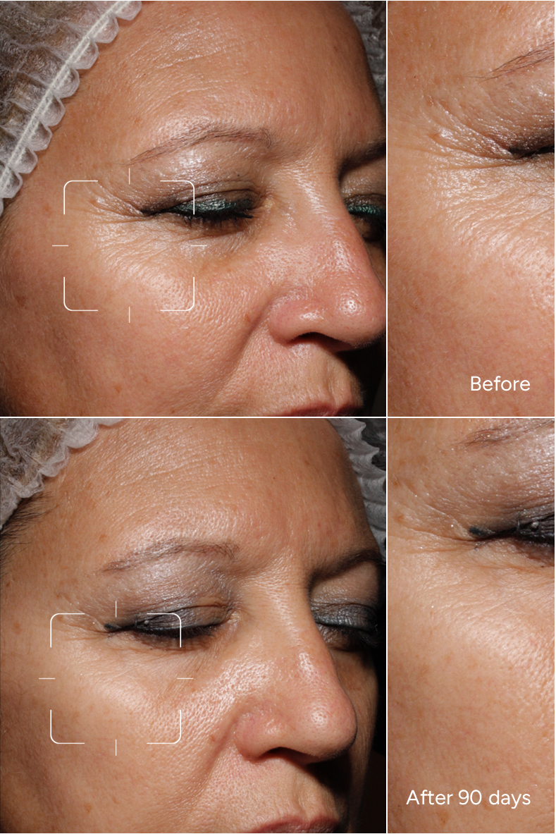 Fórmula 11 - SKIN BOOSTER - Sérum facial para abordar los primeros signos de la edad