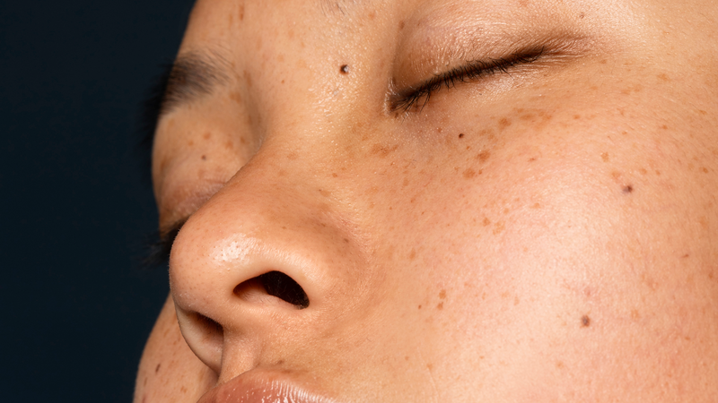 Perpigmentation Hyperpigmentation cheat sheet – Universkin