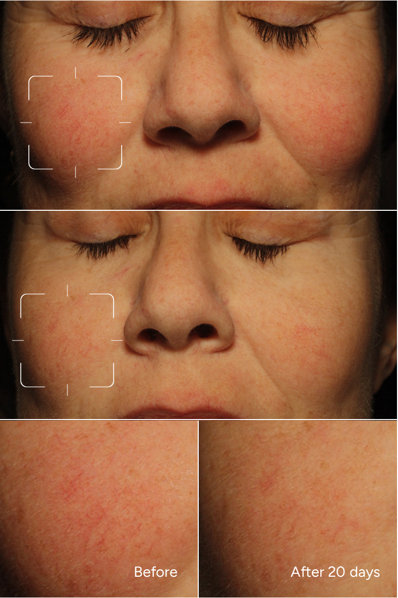 Fórmula 19 - FILTRO ROJO - Sérum facial antirojeces y cuperosis