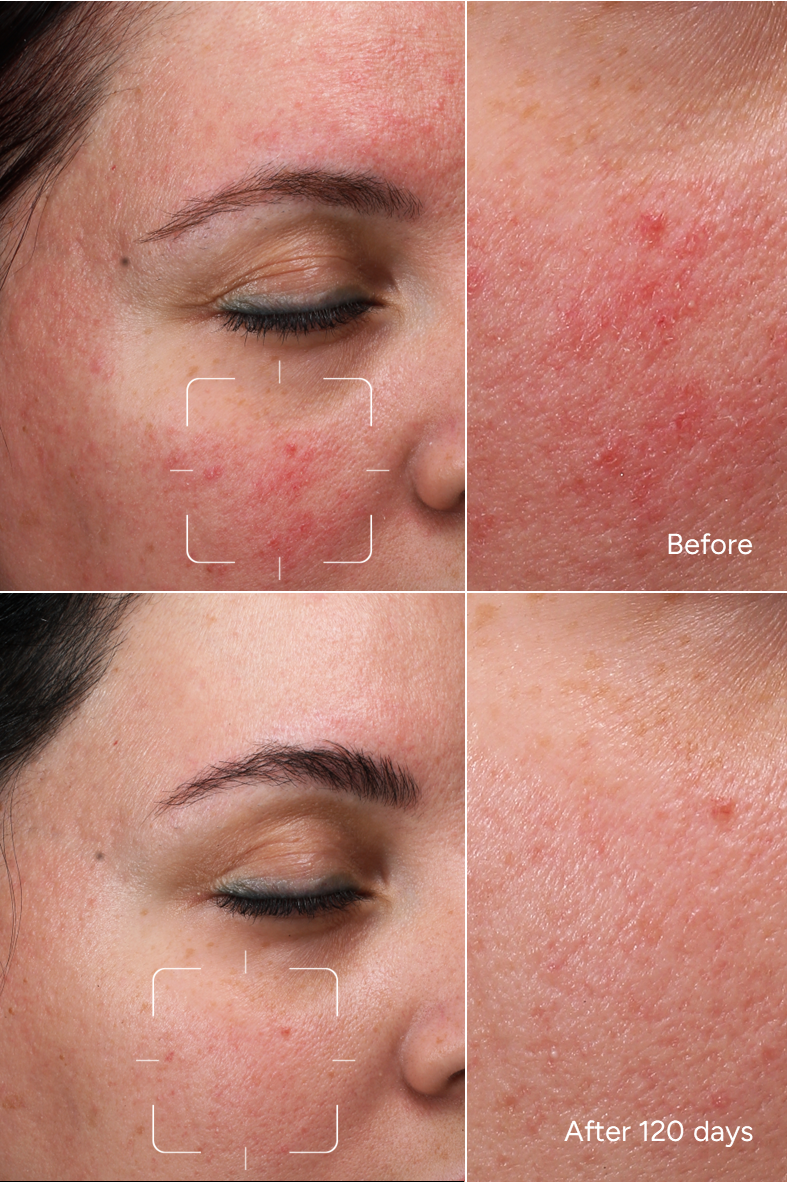 Formula 21 - RED PIMPLE - Face serum