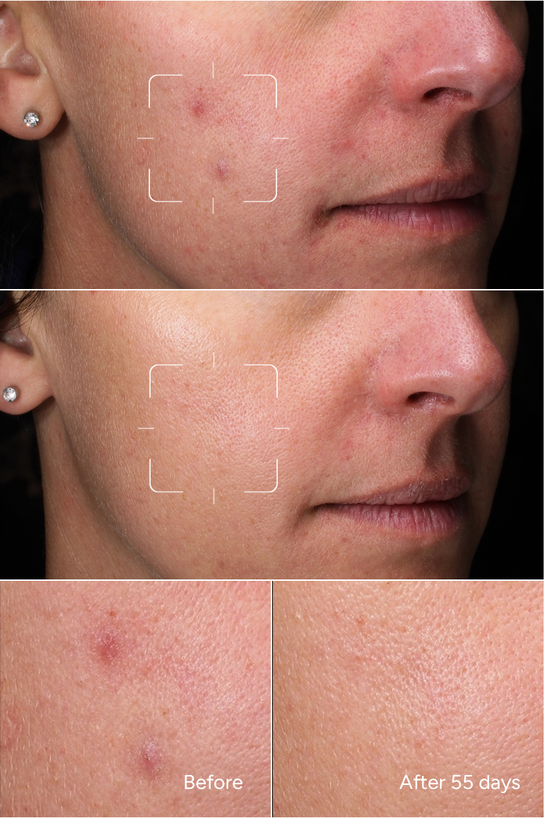 Formula 35 - Pelli sensibili a tendenza ACNE - Siero viso