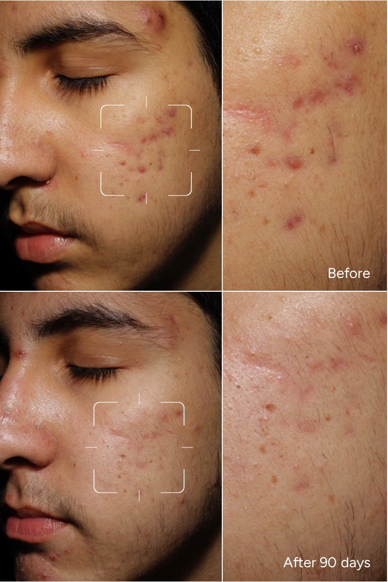 Formel 38 - ACNE Prone Mann - zu Akne neigende Haut - Gesichtsserum