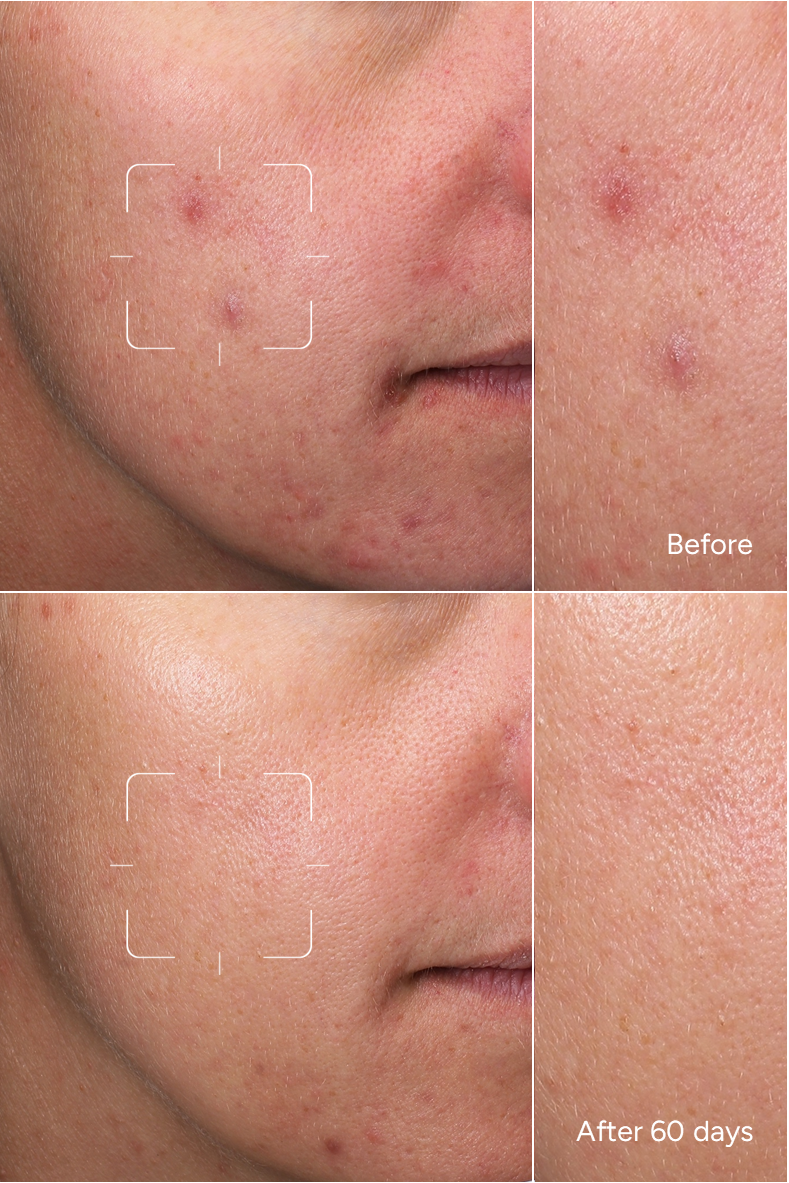 Formule 46 - HPPI - Hyperpigmentation post-inflammatoire - Sérum visage correcteur