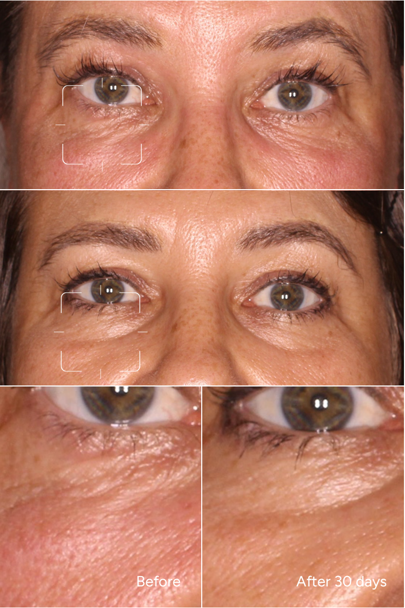 Formel 51 - Geschwollene Augen - Augenserum